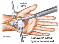CTS Surgery